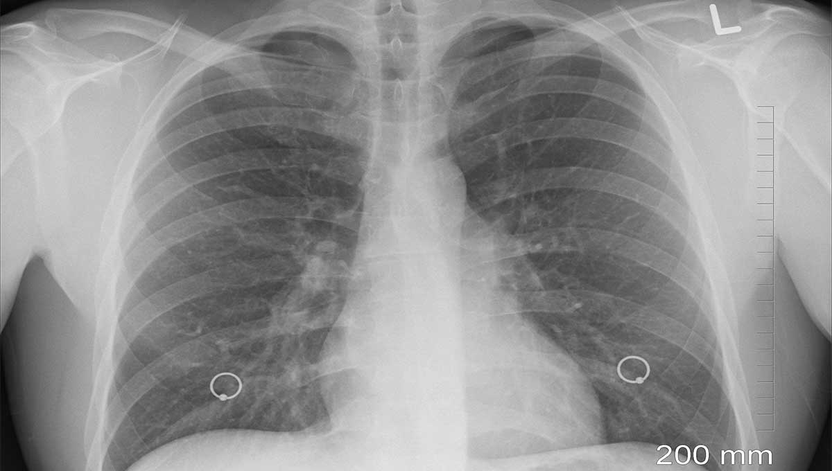 radiografía de pulmones