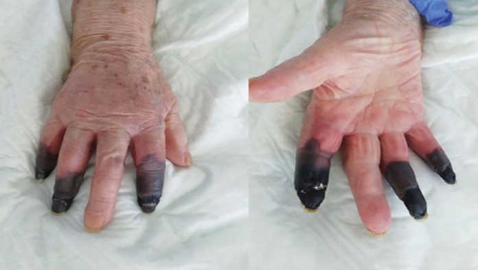 Dedos con gangrena